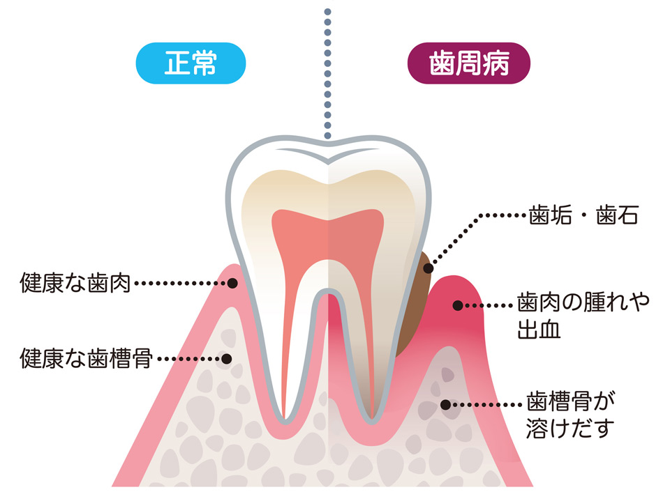 歯周病について